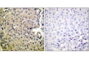 Immunohistochemistry analysis of paraffin-embedded human breast carcinoma, using PP1-alpha (Phospho-Thr320) Antibody. (PPP1CA Antikörper  (pThr320))
