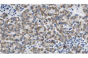 ABIN6275089 at 1/100 staining Human liver cancer tissue by IHC-P. (MYLIP Antikörper  (Internal Region))