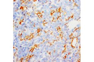 Anti-Myeloperoxidase antibody, IHC(P) IHC(P): Human Liver Cancer Tissue