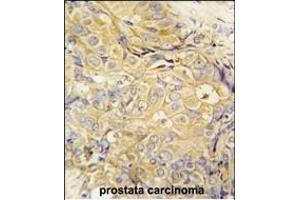 Formalin-fixed and paraffin-embedded human prostata carcinoma tissue reacted with FGF10 antibody (C-term) (ABIN392510 and ABIN2842073) , which was peroxidase-conjugated to the secondary antibody, followed by DAB staining. (FGF10 Antikörper  (C-Term))