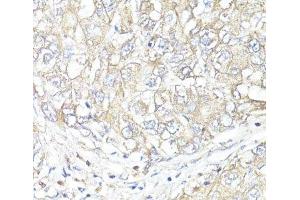 Immunohistochemistry of paraffin-embedded Human liver cancer using ATP1B1 Polyclonal Antibody at dilution of 1:100 (40x lens). (ATP1B1 Antikörper)