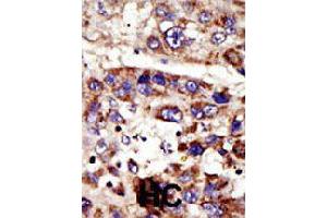 Formalin-fixed and paraffin-embedded human hepatocellular carcinoma tissue reacted with ZMPSTE24 polyclonal antibody  , which was peroxidase-conjugated to the secondary antibody, followed by DAB staining . (ZMPSTE24 Antikörper  (C-Term))