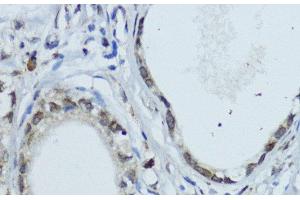 Immunohistochemistry of paraffin-embedded Human gastric cancer using NR1I3 Polyclonal Antibody at dilution of 1:200 (40x lens). (NR1I3 Antikörper)