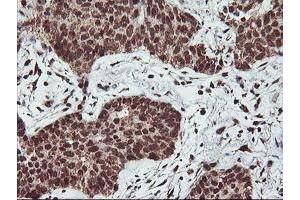 Immunohistochemical staining of paraffin-embedded Carcinoma of Human lung tissue using anti-PDE4B mouse monoclonal antibody. (PDE4B Antikörper)