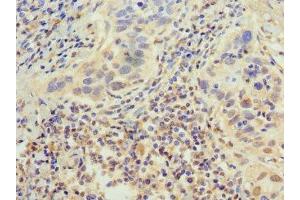 Immunohistochemistry of paraffin-embedded human bladder cancer using ABIN7155286 at dilution of 1:100 (PTGER3 Antikörper  (AA 2283-2414))