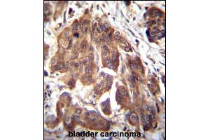 GLMN Antibody (C-term) (ABIN655986 and ABIN2845370) immunohistochemistry analysis in formalin fixed and paraffin embedded human bladder carcinoma followed by peroxidase conjugation of the secondary antibody and DAB staining. (GLMN Antikörper  (C-Term))