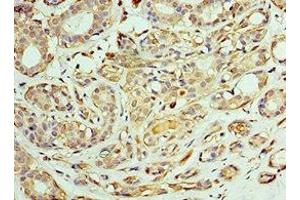 Immunohistochemistry of paraffin-embedded human breast cancer using ABIN7171432 at dilution of 1:100 (CCT6A Antikörper  (AA 80-250))