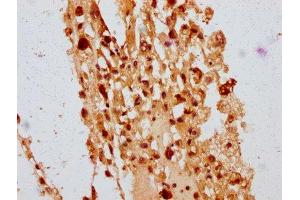IHC image of ABIN7150243 diluted at 1:400 and staining in paraffin-embedded human melanoma performed on a Leica BondTM system. (POLE4 Antikörper  (AA 8-117))