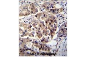 hCG_1995004 Antibody (Center) (ABIN655542 and ABIN2850483) immunohistochemistry analysis in formalin fixed and paraffin embedded human breast carcinoma followed by peroxidase conjugation of the secondary antibody and DAB staining. (hCG_1995004 (AA 116-144) Antikörper)