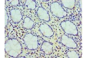 Immunohistochemistry of paraffin-embedded human colon cancer using ABIN7147595 at dilution of 1:100 (Cholecystokinin Antikörper  (AA 21-115))