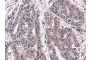 Detection of LMP7 in Human Liver cancer Tissue using Polyclonal Antibody to Large Multifunctional Peptidase 7 (LMP7) (PSMB8 Antikörper  (AA 75-261))