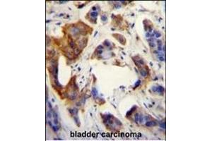 UBFD1 antibody (N-term) (ABIN655026 and ABIN2844657) immunohistochemistry analysis in formalin fixed and paraffin embedded human bladder carcinoma followed by peroxidase conjugation of the secondary antibody and DAB staining. (UBFD1 Antikörper  (N-Term))