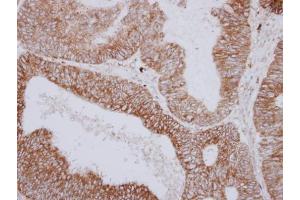 IHC-P Image Immunohistochemical analysis of paraffin-embedded human colon carcinoma, using PNPase, antibody at 1:250 dilution. (PNPT1 Antikörper  (N-Term))