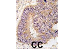 Formalin-fixed and paraffin-embedded human colon carcinoma tissue reacted with PDE8A antibody (L572), which was peroxidase-conjugated to the secondary antibody, followed by DAB staining. (PDE8A Antikörper  (AA 557-587))