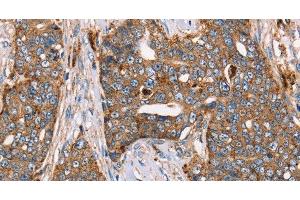 Immunohistochemistry of paraffin-embedded Human cervical cancer using FUCA1 Polyclonal Antibody at dilution of 1:30 (FUCA1 Antikörper)