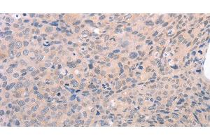 Immunohistochemistry of paraffin-embedded Human cervical cancer using EDG3 Polyclonal Antibody at dilution of 1:30 (S1PR3 Antikörper)