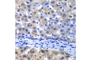 Immunohistochemistry of paraffin-embedded human liver injury using PSMD8 antibody at dilution of 1:100 (x40 lens). (PSMD8 Antikörper)