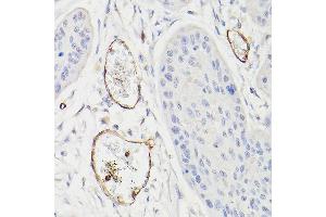 Immunohistochemistry of paraffin-embedded human esophageal cancer using CD34 Rabbit pAb (ABIN6134661, ABIN6138169, ABIN6138171 and ABIN6218103) at dilution of 1:100 (40x lens). (CD34 Antikörper  (C-Term))