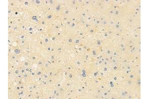 ABIN6260578 and ABIN6278244 at 1/100 staining human hepatocellular carcinoma by IHC-P. (CD163 Antikörper  (N-Term))