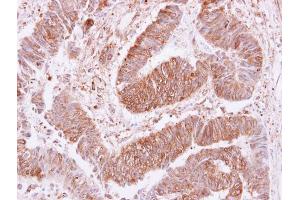 IHC-P Image VPS35 antibody [C3], C-term detects VPS35 protein at cytoplasm and membrane on human colon carcinoma by immunohistochemical analysis. (VPS35 Antikörper  (C-Term))