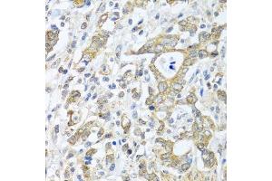 Immunohistochemistry of paraffin-embedded human gastric cancer using TICAM1 antibody. (TICAM1 Antikörper  (AA 20-200))