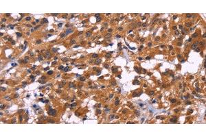 Immunohistochemistry of paraffin-embedded Human thyroid cancer tissue using MSH4 Polyclonal Antibody at dilution 1:30