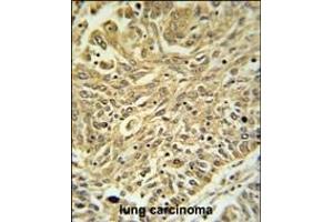 GSTK1 Antibody (Center) (ABIN653824 and ABIN2843092) IHC analysis in formalin fixed and paraffin embedded lung carcinoma followed by peroxidase conjugation of the secondary antibody and DAB staining. (GSTK1 Antikörper  (AA 93-120))