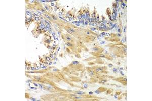 Immunohistochemistry of paraffin-embedded human prostate using PICK1 antibody at dilution of 1:100 (x40 lens). (PICK1 Antikörper)