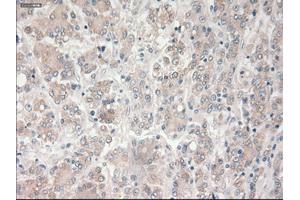Immunohistochemical staining of paraffin-embedded Carcinoma of liver tissue using anti-PROM2mouse monoclonal antibody. (Prominin 2 Antikörper)