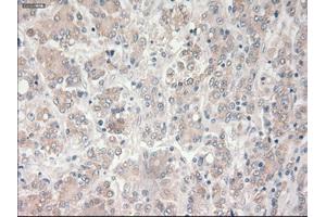 Immunohistochemical staining of paraffin-embedded Carcinoma of liver tissue using anti-PROM2mouse monoclonal antibody.