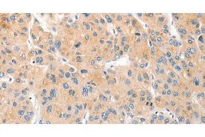 Immunohistochemistry of paraffin-embedded Human liver cancer using RPN1 Polyclonal Antibody at dilution of 1:30 (RPN1 Antikörper)