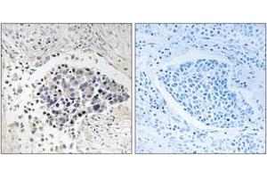 Immunohistochemistry analysis of paraffin-embedded human lung carcinoma tissue, using CPNE8 Antibody. (CPNE8 Antikörper  (AA 11-60))
