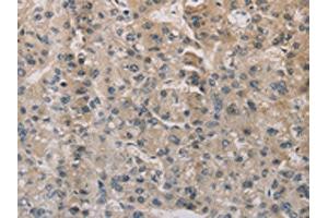 The image on the left is immunohistochemistry of paraffin-embedded Human liver cancer tissue using ABIN7129403(ESRRG Antibody) at dilution 1/30, on the right is treated with fusion protein. (ESRRG Antikörper)