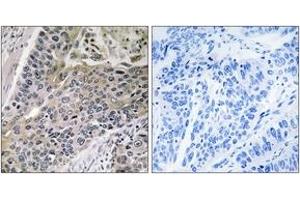 Immunohistochemistry analysis of paraffin-embedded human lung carcinoma tissue, using MRPS7 Antibody. (MRPS7 Antikörper  (AA 91-140))