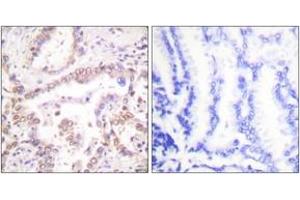 Immunohistochemistry analysis of paraffin-embedded human lung carcinoma tissue, using SKP2/p45 Antibody.