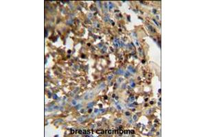 DMP4 antibody immunohistochemistry analysis in formalin fixed and paraffin embedded human breast carcinoma followed by peroxidase conjugation of the secondary antibody and DAB staining. (FAM20C Antikörper  (C-Term))
