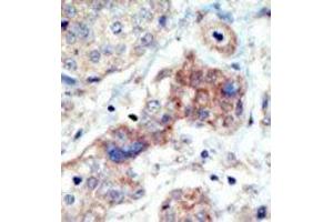 Formalin-fixed and paraffin-embedded human cancer tissue reacted with the primary antibody, which was peroxidase-conjugated to the secondary antibody, followed by DAB staining. (EPH Receptor B3 Antikörper  (N-Term))