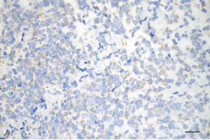 Immunohistochemistry was performed on paraffin-embedded human breast carcinoma using HDHD5 antibody (ABIN7798836), 1:200). (Rekombinanter Haloacid Dehalogenase-Like Hydrolase Domain-Containing 5 (HDHD5) Antikörper)