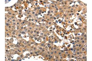 The image on the left is immunohistochemistry of paraffin-embedded Human breast cancer tissue using ABIN7190883(GRM1 Antibody) at dilution 1/15, on the right is treated with synthetic peptide. (Metabotropic Glutamate Receptor 1 Antikörper)