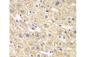 Immunohistochemistry of paraffin-embedded Human liver damage using ACADS Polyclonal Antibody at dilution of 1:100 (40x lens). (ACADS Antikörper)