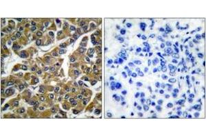 Immunohistochemistry analysis of paraffin-embedded human breast carcinoma tissue, using MMP-3 Antibody. (MMP3 Antikörper  (AA 421-470))