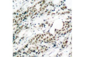 Immunohistochemistry of paraffin-embedded human breast carcinoma tissue, using Phospho-FOXO4-S197 antibody (ABIN2987524). (FOXO4 Antikörper  (pSer197))