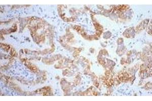 Immunohistochemistry of paraffin-embedded Human lung cancer tissue using CK-7 Monoclonal Antibody at dilution of 1:200. (Cytokeratin 7 Antikörper)