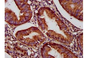 IHC image of ABIN7160839 diluted at 1:500 and staining in paraffin-embedded human endometrial cancer performed on a Leica BondTM system. (NADK2 Antikörper  (AA 16-156))