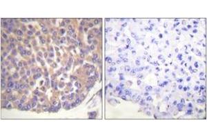 Immunohistochemistry analysis of paraffin-embedded human breast carcinoma tissue, using Filamin A (Ab-2152) Antibody. (Filamin A Antikörper  (AA 2121-2170))