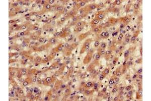 Immunohistochemistry of paraffin-embedded human liver cancer using ABIN7145235 at dilution of 1:100 (BBS1 Antikörper  (AA 435-552))