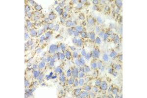 Immunohistochemistry of paraffin-embedded human esophageal cancer using ALDH4A1 antibody at dilution of 1:100 (x40 lens). (ALDH4A1 Antikörper)