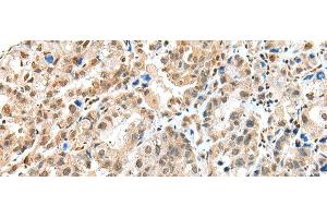 Immunohistochemistry of paraffin-embedded Human ovarian cancer tissue using S100A16 Polyclonal Antibody at dilution of 1:25(x200) (S100A16 Antikörper)