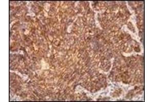 Immunohistochemistry (IHC) image for anti-Receptor tyrosine-protein kinase erbB-2 (ErbB2/Her2) (C-Term) antibody (ABIN870541) (ErbB2/Her2 Antikörper  (C-Term))