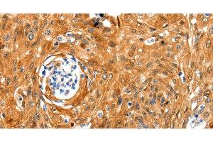 Immunohistochemistry of paraffin-embedded Human cervical cancer tissue using NCOR1 Polyclonal Antibody at dilution 1:100 (NCOR1 Antikörper)